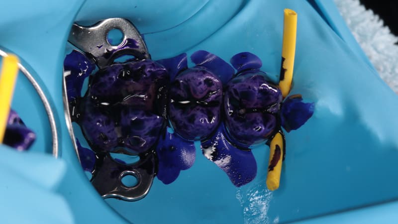 染色液とエアフローによる清掃