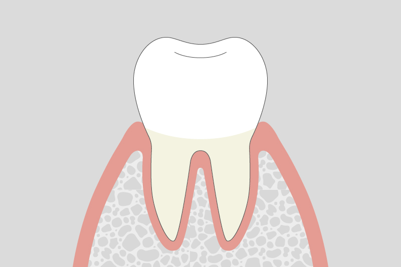 歯肉炎（軽度）